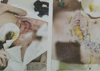Derita Qonita Salsabila (12), Sudah Berkali-kali Operasi, Orang Tua Harap Uluran Tangan Pemerintah dan Dermawan