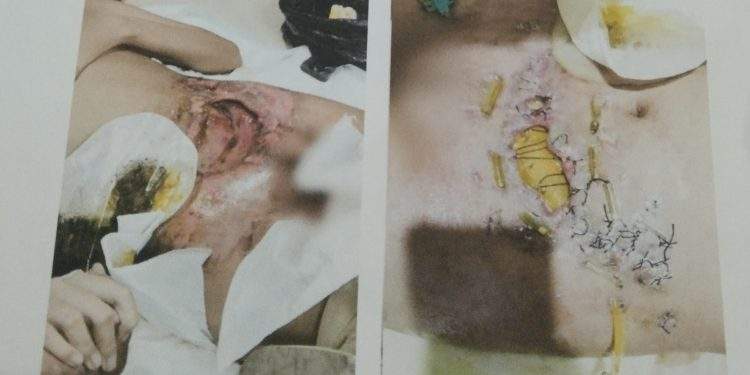 Derita Qonita Salsabila (12), Sudah Berkali-kali Operasi, Orang Tua Harap Uluran Tangan Pemerintah dan Dermawan